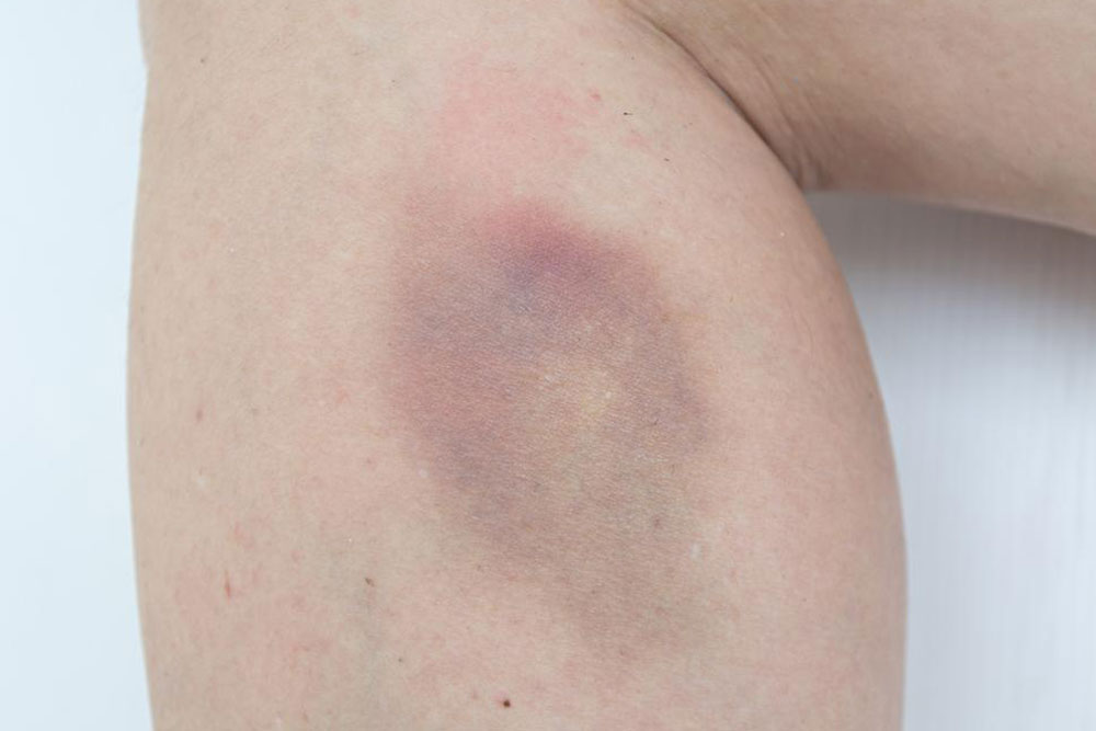 Easy bruising &#8211; Causes and treatments