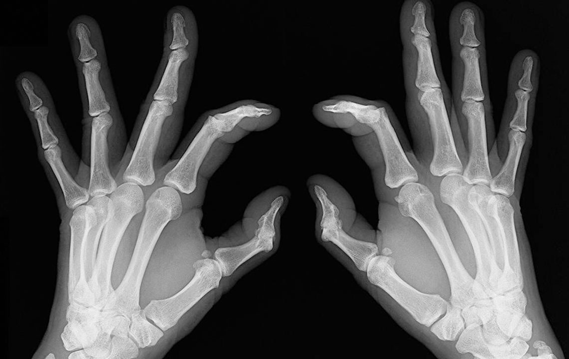 Early signs of rheumatoid arthritis and how to catch them