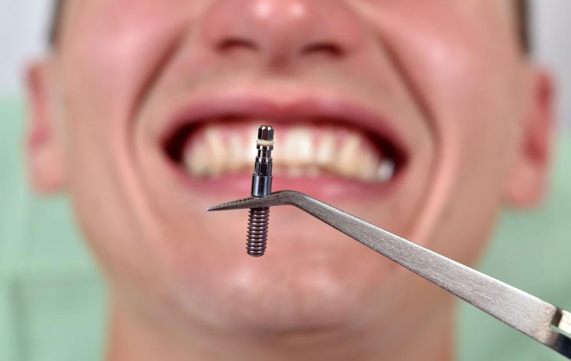 Things you should know about dental implants costs