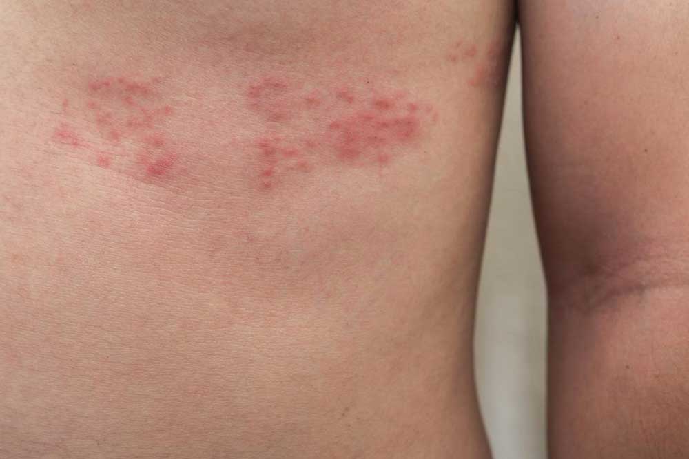 5 Ways to Deal with Shingles Nerve Pain