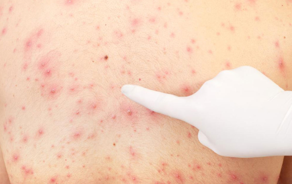 All You Need to Know About Pityriasis Rosea Treatments