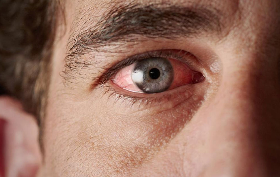 Effective Treatment Methods for Curing Red-eye