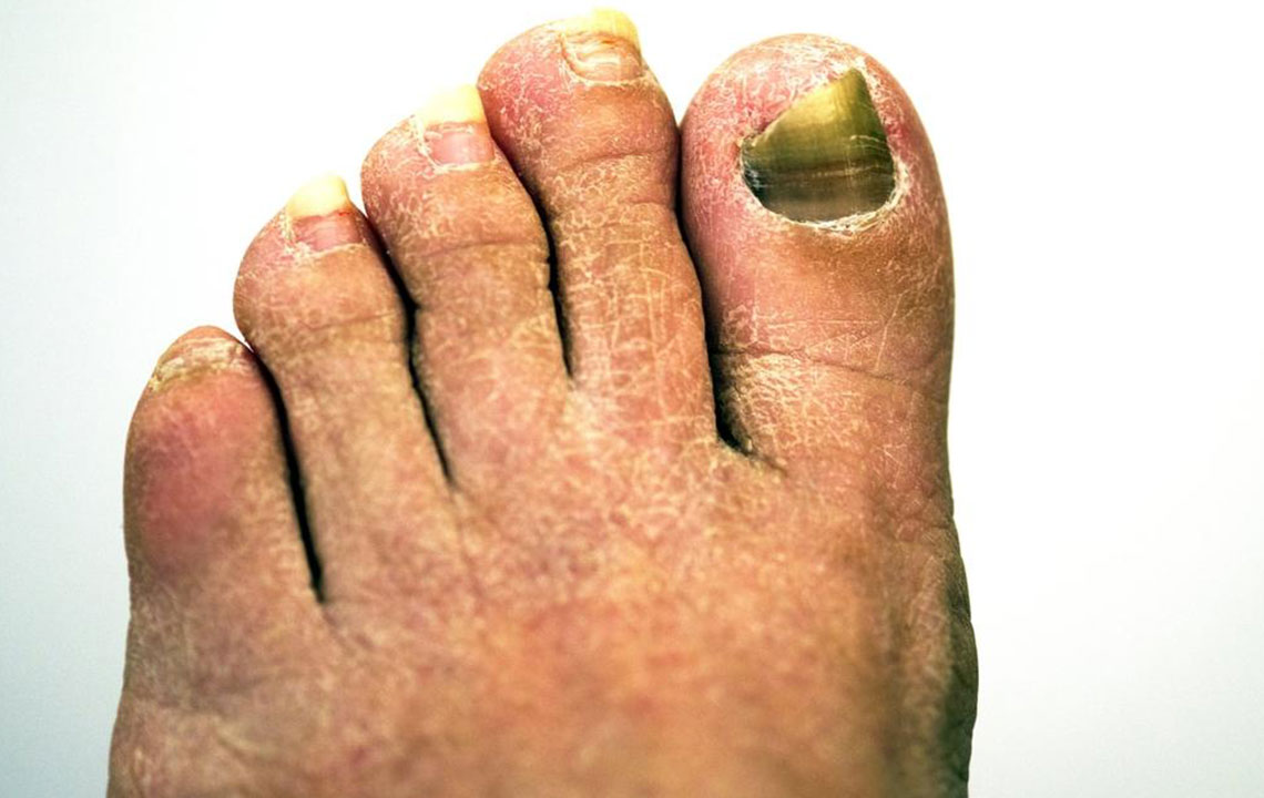 Get Rid of Toenail Fungus With the Right Treatment