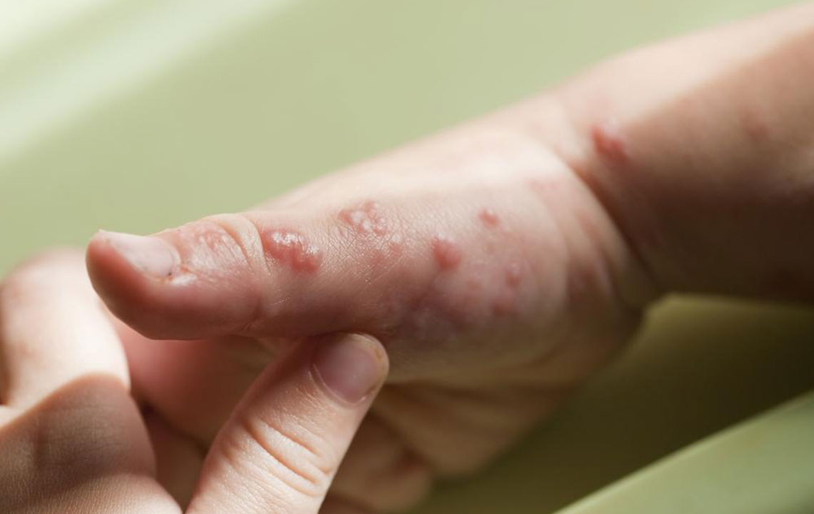 Popular Treatment Options for Shingles