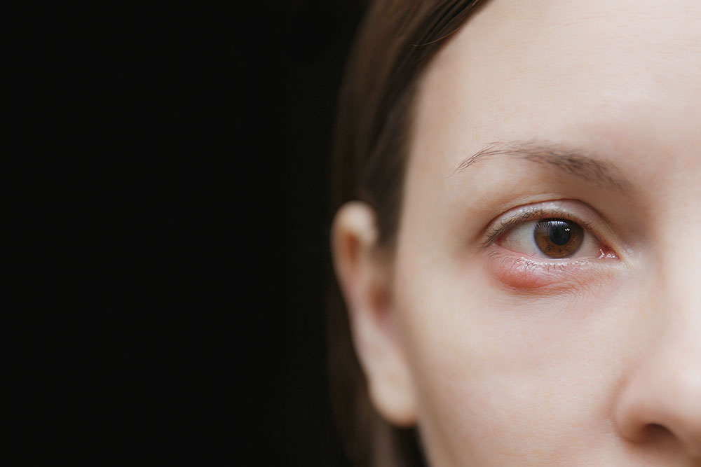 3 Ways to Get Rid of a Chalazion